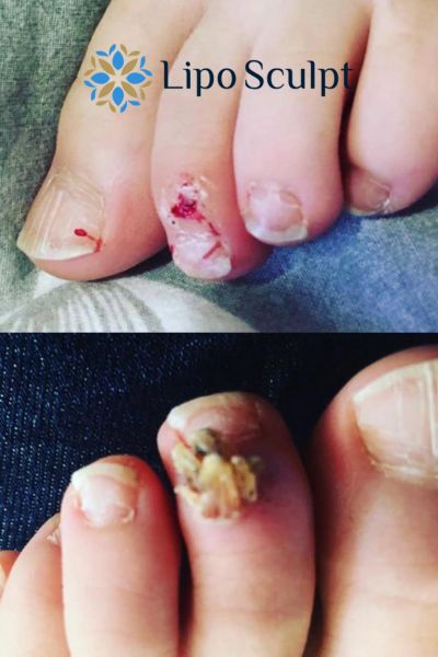 Wart removal customer results from Lipo Sculpt Tamworth